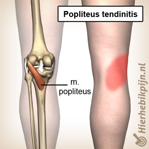 Popliteus tendinitis | Oorzaak, symptomen & behandeling