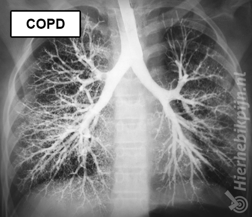 COPD | Klachten | Hier Heb Ik Pijn