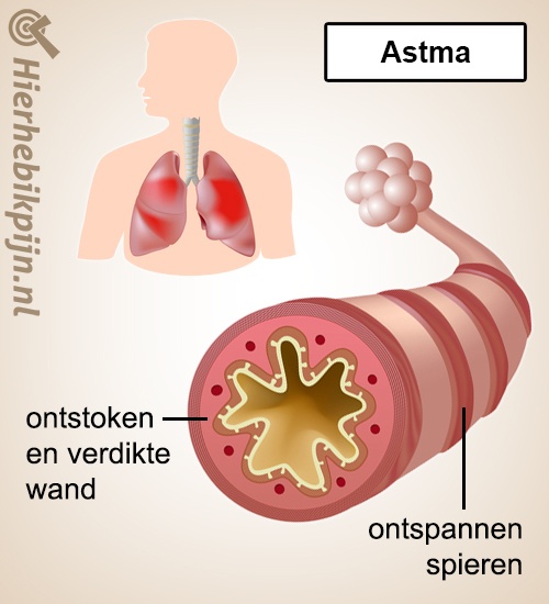 Astma | Klachten | Hier Heb Ik Pijn