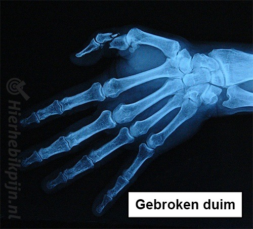 Rontgenfoto gebroken duim fractuur